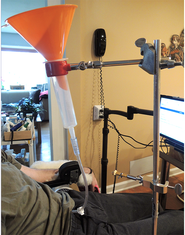 feeding tubes als
