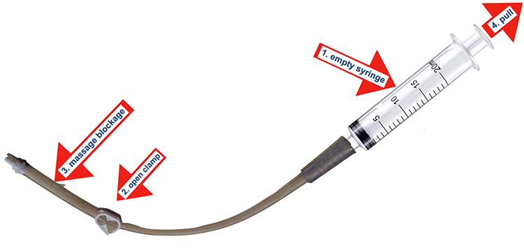 feeding tubes als