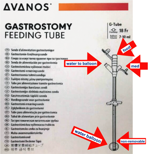 Feeding Tubes Image 2 PEG tube 500