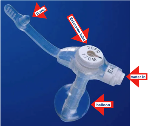 feeding tube ALS