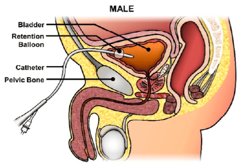 Constipation, Elimination and Urination - image12-2