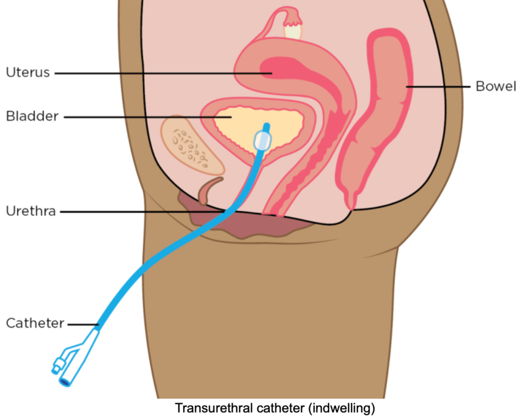 Constipation, Elimination and Urination - image5-2