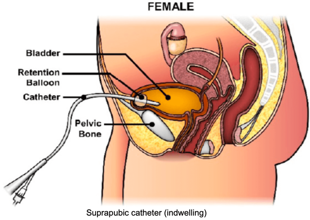 Constipation, Elimination and Urination - image6-2